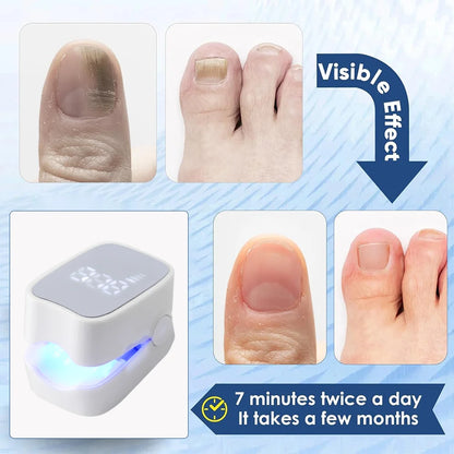 Effective Nail Fungus Treatment Tool